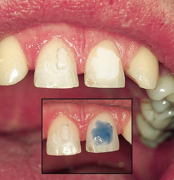 etching process bonding dental filling dentistry technique techniques discolouration fillings medeco