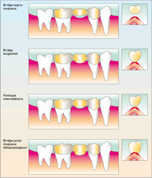 types de ponts dentaires