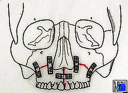 Miniplattenosteosynthese bei Le-Fort-I-Fraktur