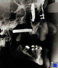 Situation nach Le-Fort-III-Osteotomie und Vorverlagerung des Mittelgesichts, Fixation durch Miniplattenosteosynthese und Einlagerung von Knochentransplantaten in die Spalträume