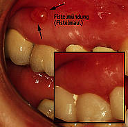 Fistelrückbildung drei Tage nach einer Wurzelkanalbehandlung