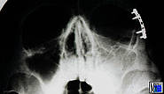 Miniplattenosteosynthese am lateralen Orbitarand zur Fixation einer Jochbeinfraktur. Die Kieferhöhle ist durch Einblutung vorübergehend verschattet.