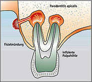 Fistel bei apikaler Parodontitis