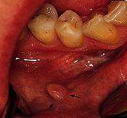 Fibrom – gutartiger Tumor