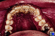 Akute nekrotisierende ulzeröse Gingivitis (ANUG)