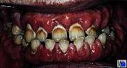 Hyperplastische Gingivitis