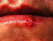 Lippenherpes