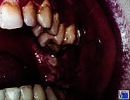 Ulzeröse Gingivo-Stomatitis. Differenzialdiagnose: Karzinom