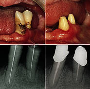 Wurzelkanalbehandlung vor Eingliederung von Teleskopkronen