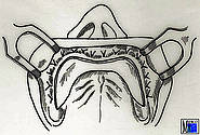 Mundvorhofplastik mit sekundärer Epithelisierung: Abtrennung der beweglichen Schleimhaut und der Muskulatur vom Periost mit Vernähung des Schleimhautrandes in der neu geschaffenen Umschlagsfalte. Die Periostwunde heilt über die freie Granulation.