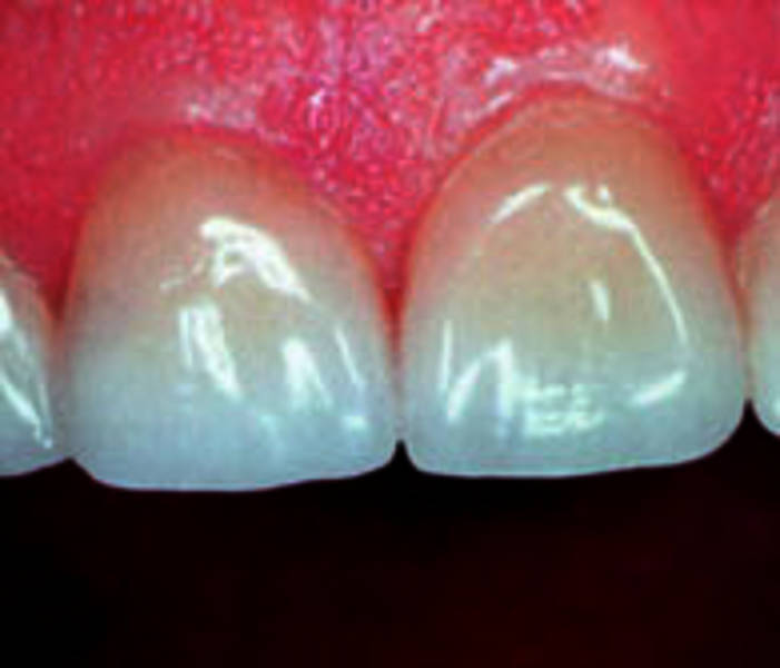 La couronne dentaire en 3 questions - Dentisterie Hanok