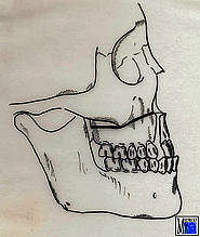 Le-Fort-I-Osteotomie und Vorverlagerung des Oberkiefers mit Knocheneinpflanzung im Bereich der Fossa canina und am Processus pterygoideus zur Behandlung einer maxillären Retrognathie bei Spaltkiefer