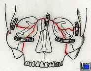Miniplattenosteosynthese bei Le-Fort-III-Fraktur mit isolierter Aussprengung der Jochbeine