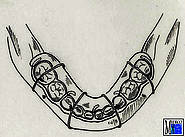 Fixation einer Lingualschiene mit vier perimandibulären Drahtumschlingungen im Milchgebiss