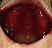 Stomatitis prothetica, Prothesenende genau erkennbar