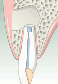 Wurzelspitze nach Entfernung der Entzündung und nach Wurzelfüllung