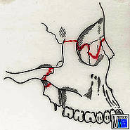 Mittelgesichtsfraktur Le Fort III
