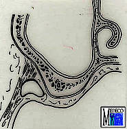 Submuköse Mundvorhofplastik im Oberkiefer (Obwegeser): Nach Unterminierung der Schleimhaut (Z85 und Z86) wird die Muskulatur vom Periost abgelöst (Z87). Die mobilisierte Schleimhaut wird mit der verlängerten Prothese der Wundfläche adaptiert (Z88).