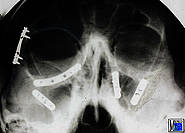 Miniplattenosteosynthese am lateralen und kaudalen rechten Orbitarand und an der Crista zygomatico-alveolaris beiderseits und an der linken Apertura piriformis bei Le-Fort-III-Fraktur rechts und Le-Fort-II-Fraktur links