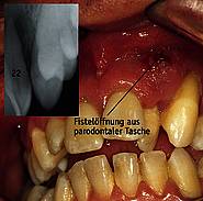 Parodontalabszess nach Spontaneröffnung