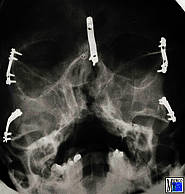 Situation nach Le-Fort-III-Osteotomie und Vorverlagerung des Mittelgesichts, Fixation durch Miniplattenosteosynthese und Einlagerung von Knochentransplantaten in die Spalträume