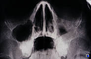 Teilverschattung der linken Kieferhöhle