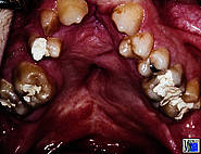 Maxilläre Retrognathie und Kompression bei voroperierter doppelseitiger Lippen-Kiefer-Gaumen-Spalte. Der Zwischenkiefer mit den oberen Schneidezähnen fehlt.