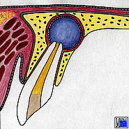 Radikuläre Zyste an einem oberen Schneidezahn. Aus Krüger, E.: Farbatlas der dentoalveolären Chirurgie, Hüthig (1997)