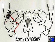 Miniplattenosteosynthese bei Jochbeinfraktur
