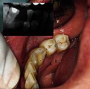 Mit  „X“ gekennzeichnete Lage des zusätzlichen Prämolaren