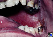 Derselbe Patient mit erweiterter Mundöffnung in Narkose. Gaumensegel auf der linken Seite vorgewölbt und gerötet.