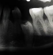 Retinierter Prämolar