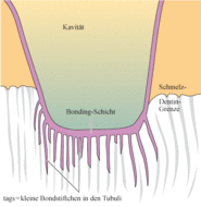 Dentinbonding