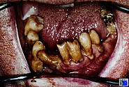 Derselbe Patient: Fortgeschrittene marginale Parodontitis