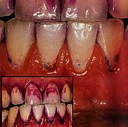 Gingivale Blutung nach vorsichtigem Beginn der Belagentfernung