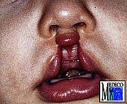 Doppelseitige Lippenspalte
