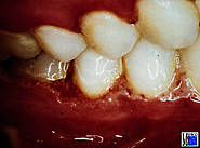 HIV-assoziierte akute nekrotisierende ulzeröse Gingivitis. Aus Kuntz, A. et al.: Dtsch Z Mund Kiefer Gesichts Chir 11: 157 (1987)