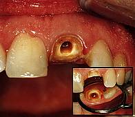 Zahnstumpf nach Wurzelbehandlung