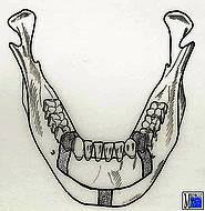 Ostektomie am Alveolarfortsatz in Höhe der ersten Prämolaren und am Kinnrand nach Spiessl