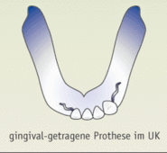 Gingival getragene Prothese