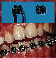 Brackets im UK; mit Gummiligaturen befestigter Bogen