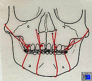 Zygomatiko-maxilläre Aufhängung des Unterkiefers
