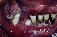 Osteomyelitis mit Eiterentleerung nach Extraktion 47, 46, 45, 44, 43