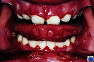 Gingivo-Stomatitis herpetica (Stomatitis aphthosa)