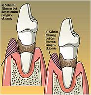 Gingivektomie