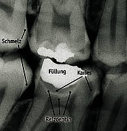 Tertiärdentinbildung bei Karies