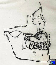 Le-Fort-I-Osteotomie und Vorverlagerung des Oberkiefers mit Knocheneinpflanzung im Bereich der Fossa canina und am Processus pterygoideus zur Behandlung einer maxillären Retrognathie bei Spaltkiefer