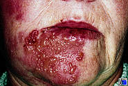 Herpes zoster des rechten 3. Trigeminusastes